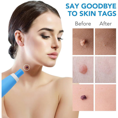 Skin Tag Remover Kit 2 In 1 For Micro To Large (2 Mm - 8 Mm  1 Set)